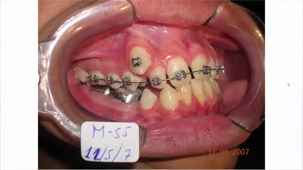 Mordida cruzada esqueletal posterior Parte III: Tratamiento con disyuntor de Hyrax y mini implantes negocios desde casa