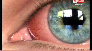 العيادة - د.إيهاب سعد - فيديو يوضح إلتهابات ملتحمة العين - The Clinic