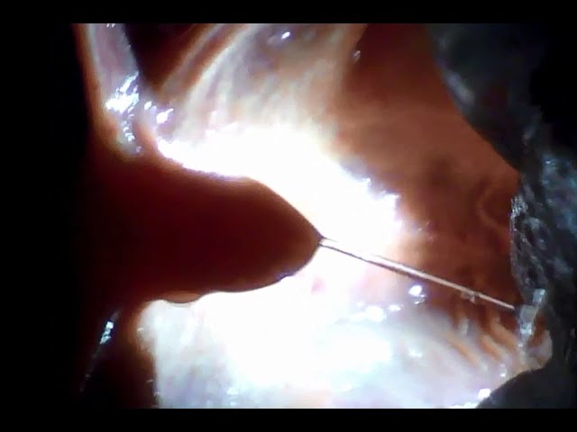 Endoscope Vore