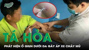 Kinh hãi hình ảnh giun rồng chui lên qua da, phát hiện nhiều ổ giun áp xe khắp cơ thể |SKĐS