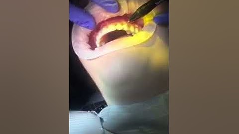 Part II: Digital Smile Design Clean-up & Perfection of the Mock-up....PLUS tips and tricks