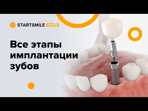 Установка импланта зуба | Все этапы операции