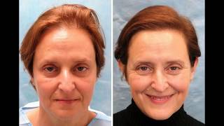 Female Hair Transplant Photos: Amazing Results!