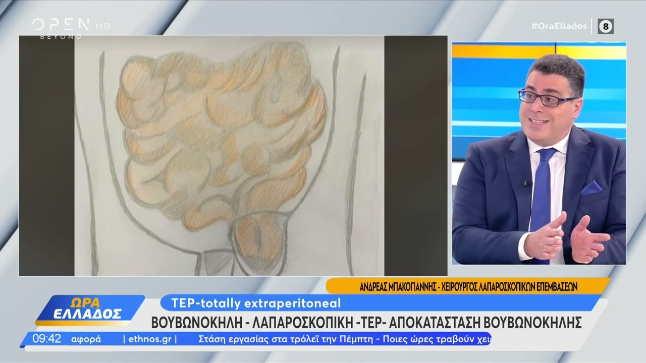 βουβωνοκήλη η καλύτερη μέθοδος