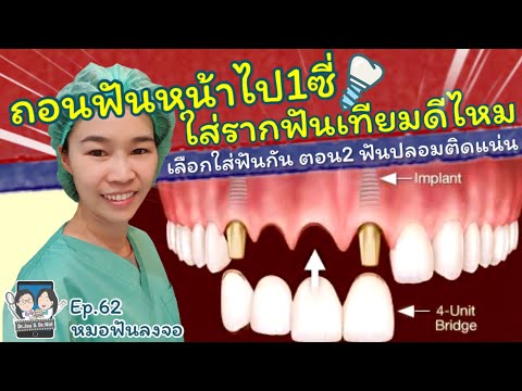 ถอนฟันหน้าไป1ซี่ ใส่รากฟันเทียมดีไหม? |หมอฟันลงจอ |#สะพานฟัน #รากฟันเทียม #dentalimplant