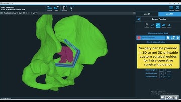 OrthoOncoAI - AI-based CT+MRI merging and 3D reconstruction for Tumor-Bone surgery planning