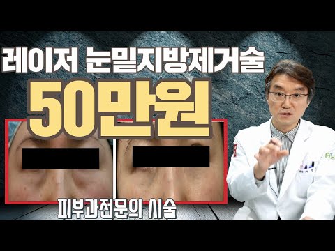   눈밑지방제거 비용 50만원 레이저를 이용한 눈밑지방제거술 피부과전문의 시술