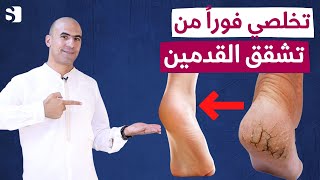 تخلصي نهائيا من تشققات القدم وجفاف الجلد وخشونة القدمين بخطوات سهلة في ايام | علاج فعال سريع