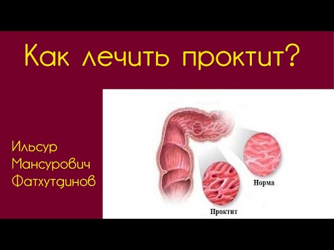 Как лечить проктит?