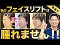 【たるみ解消】切開フェイスリフトは術後に病むの？気になるダウンタイムを大公開！
