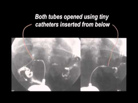 Video: Fallopian Tubes Funktion, Billeder & Definition - Body Maps