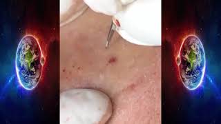 BLACKHEADS AND CYSTIC ACNE REMOVAL ON MAN'S FACE || Acne Treatment Update 2021