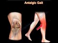 Painful Gait, Antalgic Gait, painful gait.