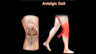 Painful Gait, Antalgic Gait, painful gait. by nabil ebraheim 4,272 views 2 months ago 2 minutes, 56 seconds