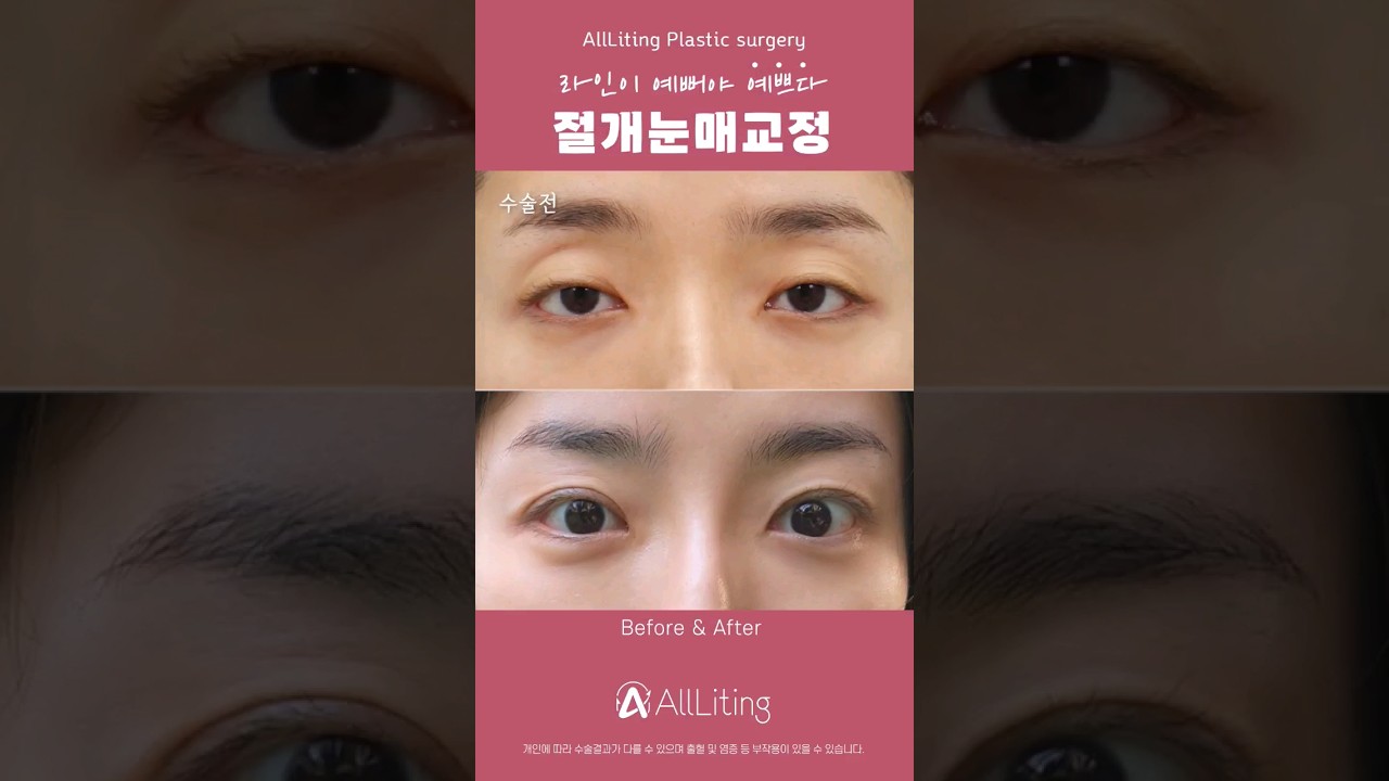 [Оллитинг гоо сайхны мэс заслын эмнэлэг] 😘 Унтаархай харагдах нүднээс салах! Тод бөгөөд үзэсгэлэнтэй нүдтэй болоорой.