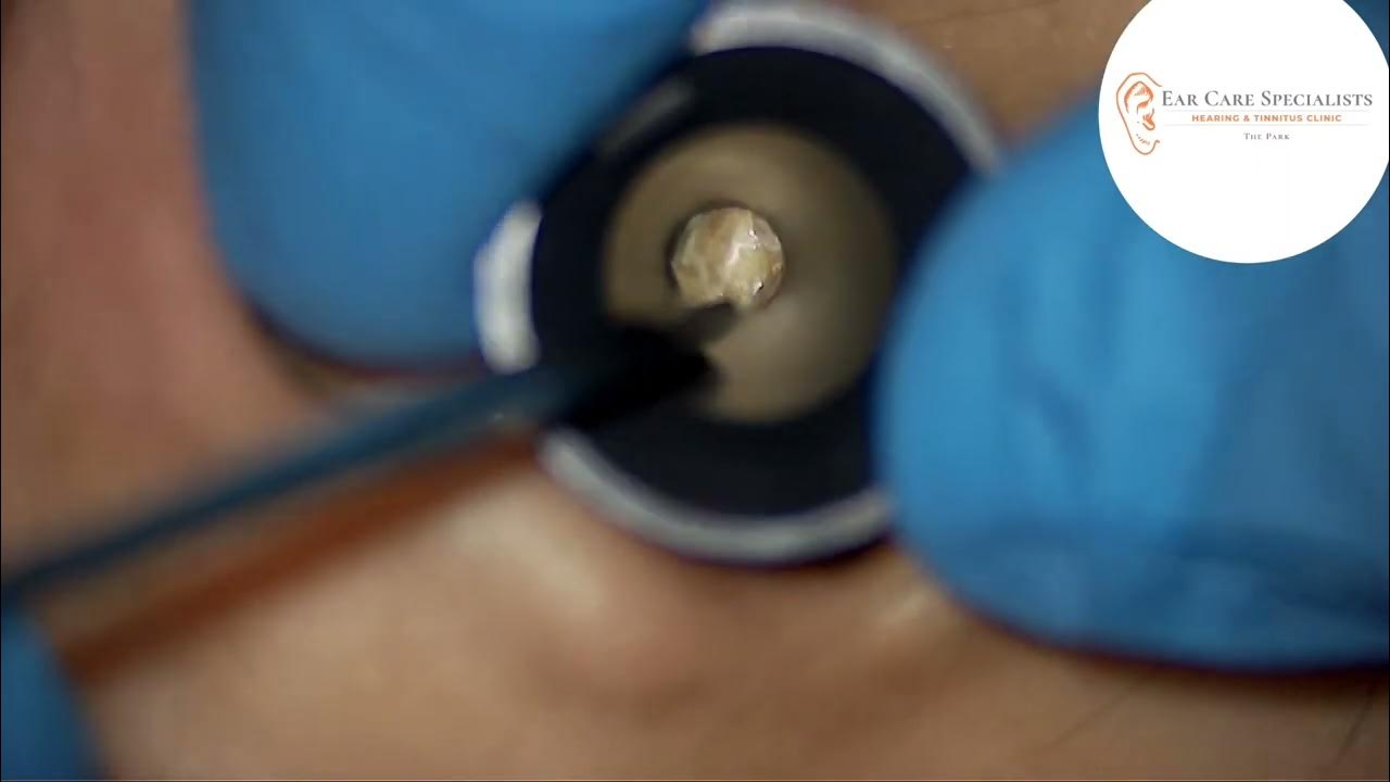 Battling with a dense keratin plug ear earwax earwaxremoval skin 
