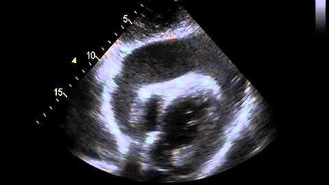 Echocardiography with a Significant Pericardial Effusion