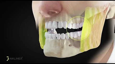 JAWLINER Jaw muscle workout - how it works - mewing
