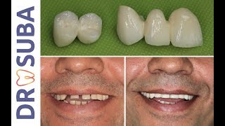 BRIDGE DENTAIRE :  Comment fait le dentiste le prothésiste
