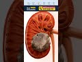 Kidney Stone Surgery का खर्च कितना है? RIRS vs PCNL Explained #shorts