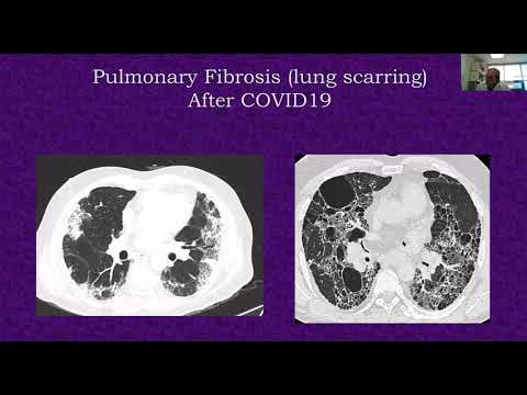 Post-COVID-19 Symptoms and
