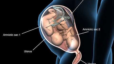 Types of twins pregnancy - Monochorionic diamniotic twins - 3D Anatomical Visualization