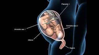 Types of twins pregnancy - Monochorionic diamniotic twins - 3D Anatomical Visualization