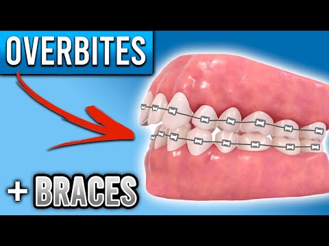 Overbite Bridge How Do They Fix An Overbite With Braces