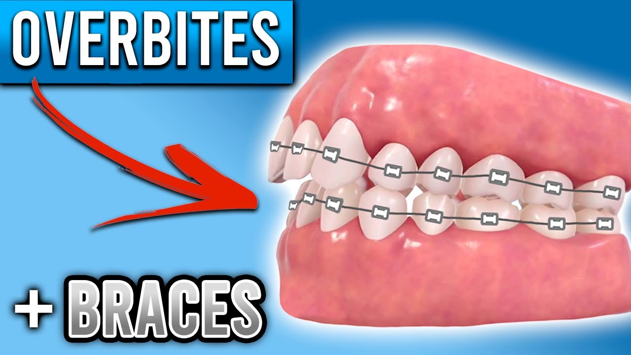 How Do BRACES FIX Overbites?  Overbite Before and After Braces