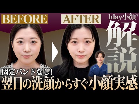 【激変】1時間で顔の余白が消えた…？固定バンド不要の「1day小顔®︎」で友達に痩せたと言われるまで密着！