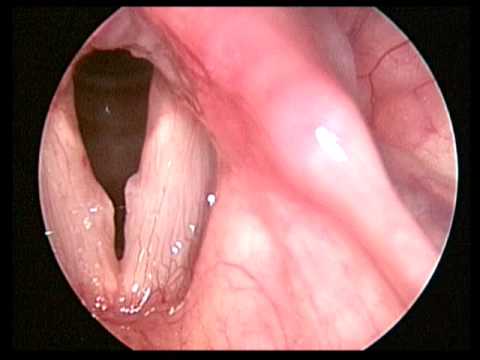 聲帶長繭 喉顯微手術前 Vocal Nodules Pre Laryngomicrosurgery Youtube