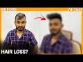 Hair Patch For Men In Delhi| Most natural looking hair patch for men| 100% natural human hair patch