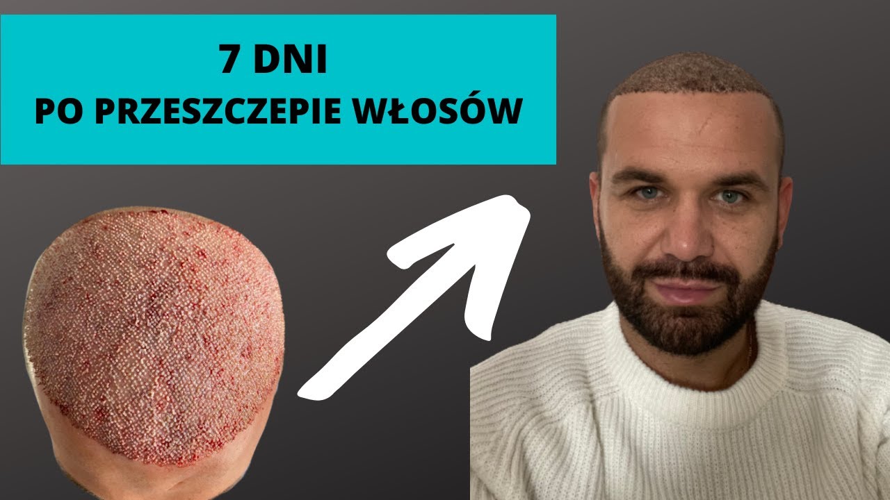Przeszczep włosów w Turcji - RELACJA, ZDJĘCIA - 7 dni po zabiegu. - YouTube