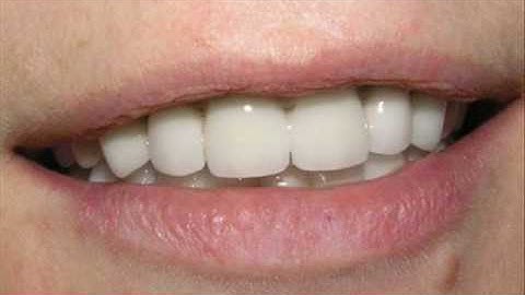 Complete Reconstruction - 9