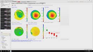 08 Insight 100 Keratoconus Evaluation