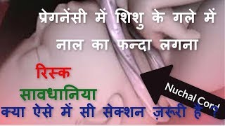 अगर शिशु के गले में नाल लिपट जाए | If Umbilical cord wraps around baby neck | Nuchal Cord