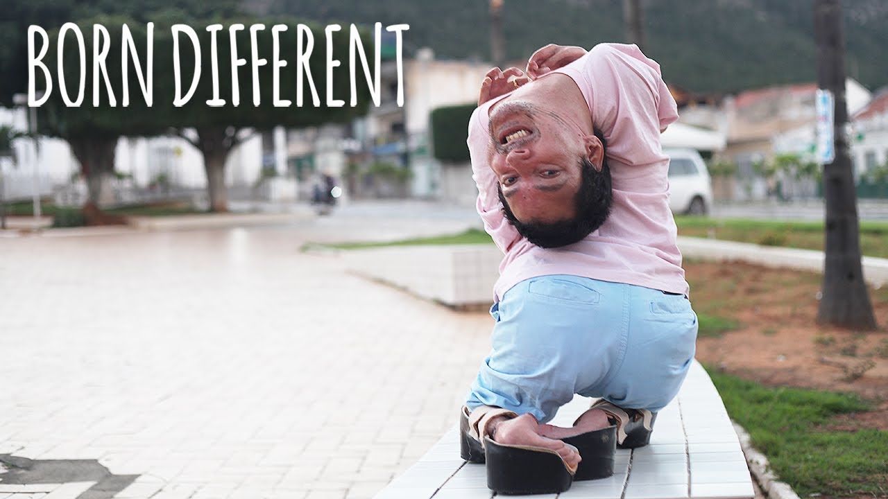 The man with the upside down head - born different