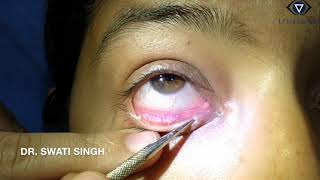 Lacrimal Syringing- Technique and Interpretation