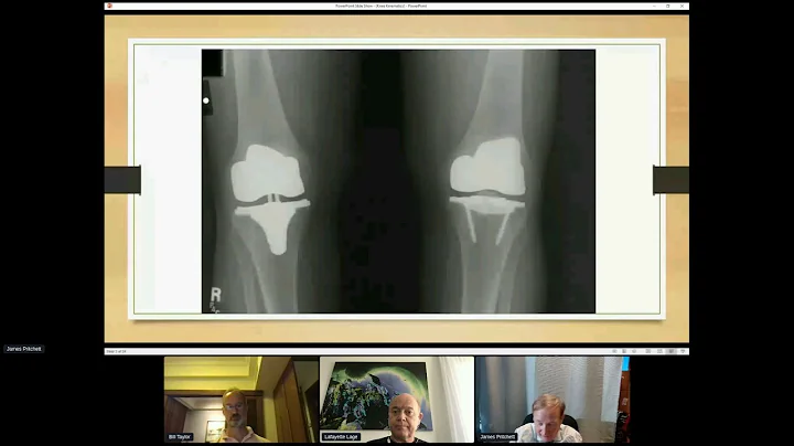 Knee Replacement Preferences -Pritchett Factor