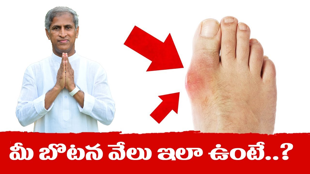 Gout Arthritis & Foods to Avoid for Gout in Telugu Dr Manthena