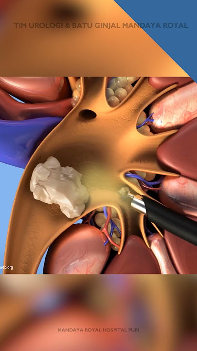 Metode Laser Batu Ginjal Tanpa Operasi RIRS & PCNL - Mandaya Royal Hospital Puri