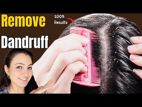 How to Cure Dandruff Itchy Scalp Naturally | Remove Dandruff In Just 1 Wash Permanently 💕