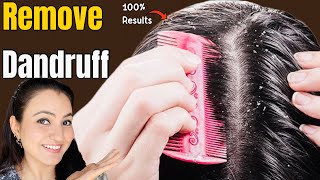 How to Cure Dandruff Itchy Scalp Naturally  | Remove Dandruff In Just 1 Wash Permanently 💕