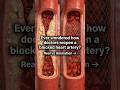 Real vs Animation: How a Stent Opens a Blocked Heart Artery 🔥 #heartstent #shorts #trending #viral