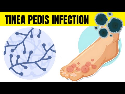 Tinea Pedis Infection (Athlete's Foot) - Causes, Types, Signs & Symptoms, And Treatment