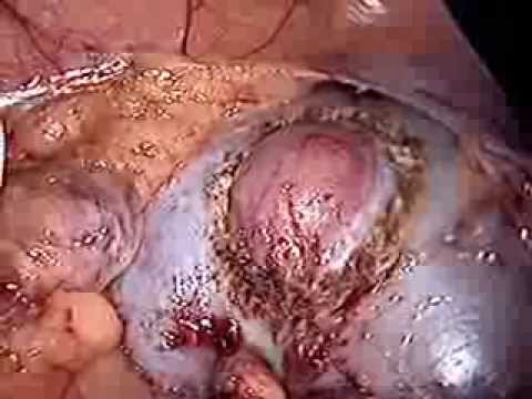 Laparoscopic Right Partial Nephrectomy In UKC Ljubljana