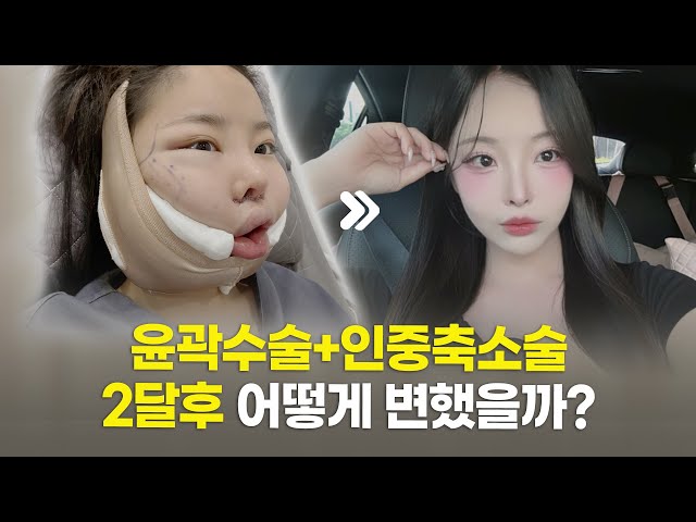 예쁜데, 더 예뻐졌다😍 윤곽수술(광대, 사각턱), 인중축소술 후기💖