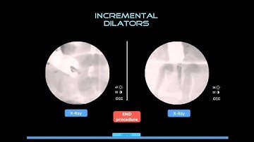Spinal Fixation Simulation - ExRayLab