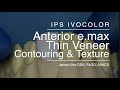 A CEREC e.max Veneer Contouring & Shaping