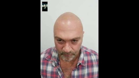 50 year old gets scalpmicropigmentation by Jonathan Gerow